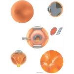 Cataracts Complications of Cataract Surgery