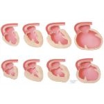 Congestive Heart Failure; Hypertrophy of Heart
