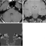 Seventh Nerve Hemangioma
