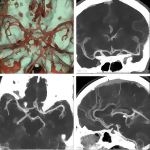 Arterial Imaging With CT and MRI