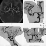 Arterial Imaging With CT and MRI