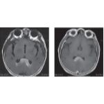 Primary CNS Lymphoma