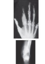 Renal Steodystrophy and Secondary Hyperparathyroidism