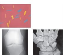Calcium Prophosphate Dihydrate Crystal Deposition Disease
