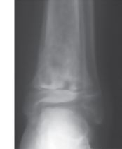 Radiographic Changes In Healing Phyase of Late Acute Hematogenous Osteomyeltis