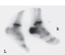 Bone Scan In Acute Osteomyelitis