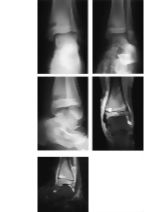 Subacute Osteomyelitis