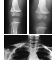 Subacute Osteomyelitis