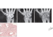 Septic Arthritis
