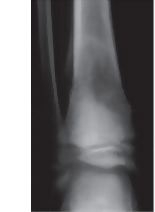 Bone Destruction In Osteosarcoma