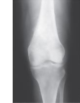 Neoplasms In Bone