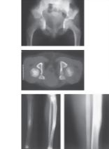 Osteoid Osteoma