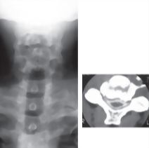 Cervical Spondylosis With Myelopathy