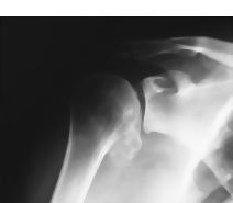 Osteoarthritis of the Shoulder
