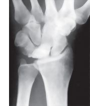 Radiograph In Kienb&ouml;ck Disease
