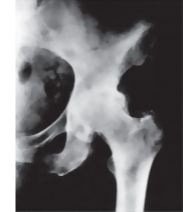 Osteoarthritis of the Hip