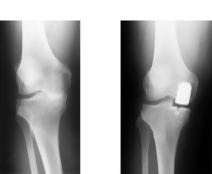Unicondylar Knee Arthroplasty