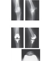 Total Knee Arthroplasty
