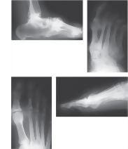 Radiographs Depicting Arthritis In Various Sites of the Foot