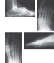 K&ouml;hler Disease