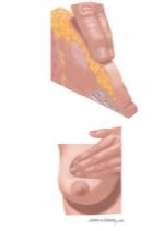 Fibroadenoma