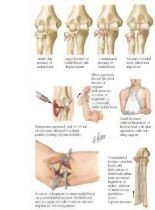Neck Of Radius