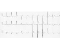 Electrocardiography ECG Changes of LV Hypertrophy