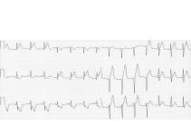 ST-Segment Changes Associated With an Acute Ischemic Event