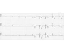 T-Wave Changes Induced By a Recent Ischemic Event