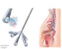 Transesophageal Echocardiography