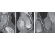 Computed Tomography (CT) Coronary Angiography