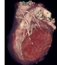 3D Cardiac Computed Tomography Volume Rendering