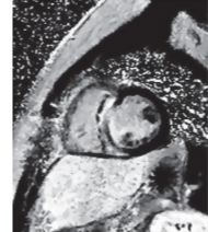Sarcoidosis: CMR Phase-sensitive Inversion Recovery