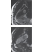 Blood Sequences Showing Left Atrial Myxoma