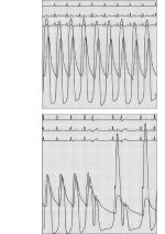 Simultaneous Pressure Tracings From the Left Ventricular Apex and Aorta In Aortic Stenosis