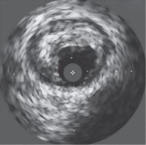 Intravascular Ultrasonogram of Coronary Atherosclerosis