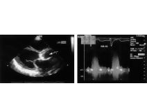 Two-Dimensional Echocardiography and Doppler Analysis In a Patient With Aortic Stenosis
