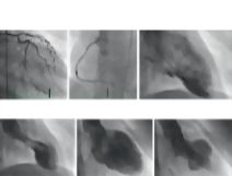 Takotsubo Cardiomyopathy