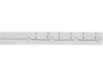 Second-degree Atrioventricular Block