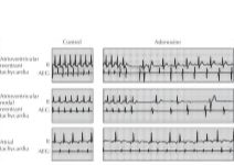 Effect of Adenosine On Atrioventricular Reentrant Tachycardia, Atrioventricular Nodal Reentrant Tachycardia, and Atrial Tachycardia