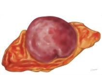 Pheochromocytoma and Paraganglioma
