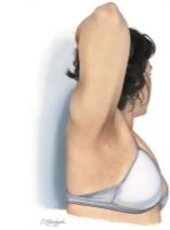 Neurofibromatosis Type 1: Von Recklinghausen's Disease