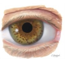 Neurofibromatosis Type 1: Von Recklinghausen's Disease
