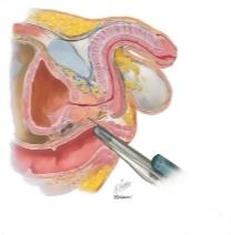Carcinoma of Prostate III: Diagnosis, Treatment, Palliation