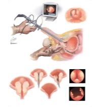 Benign Prostate Surgery IV: Transurethral