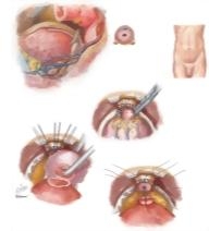 Malignant Prostate Surgery I: Retropubic