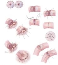 Azoospermia III: Reproductive Microsurgery