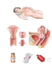 Dysmenorrhea