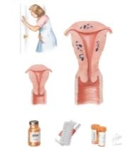 Adenomyosis