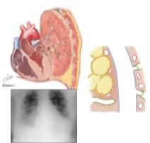 Heart Disease In Pleural Effusion